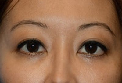 Blepharoplasty Before & After Gallery - Patient 768011 - Image 2