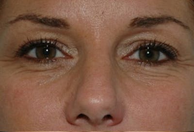 Blepharoplasty Before & After Gallery - Patient 307736 - Image 1