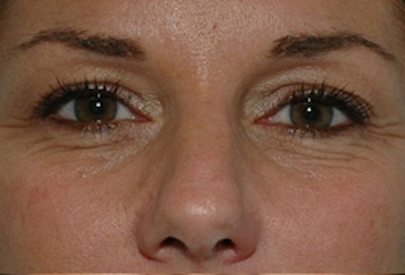 Blepharoplasty Before & After Gallery - Patient 307736 - Image 1