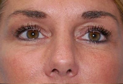 Blepharoplasty Before & After Gallery - Patient 307736 - Image 2