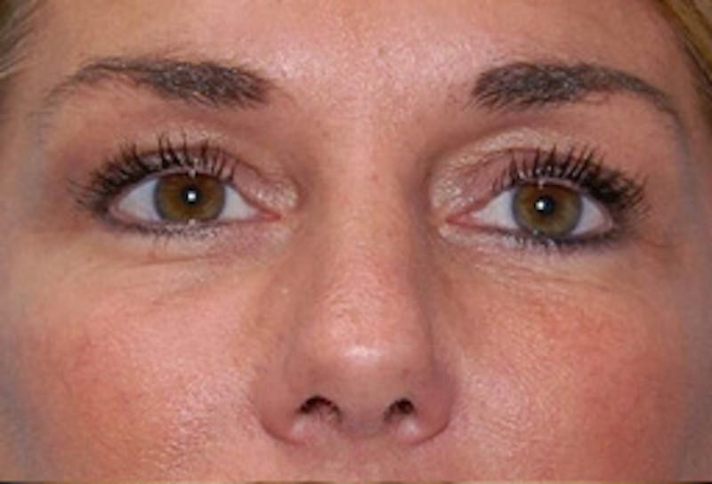 Blepharoplasty Before & After Gallery - Patient 307736 - Image 2