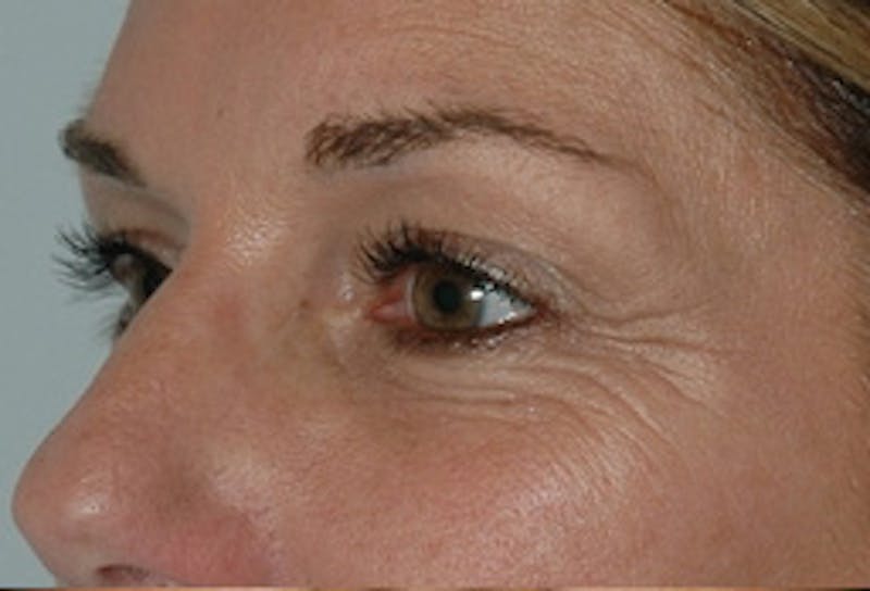 Blepharoplasty Before & After Gallery - Patient 307736 - Image 3