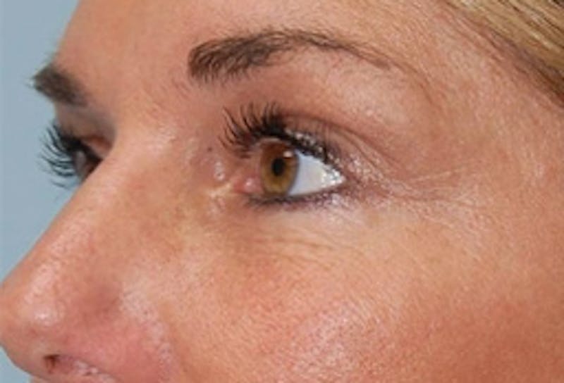 Blepharoplasty Before & After Gallery - Patient 307736 - Image 4