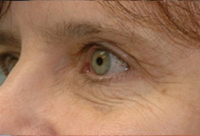 Blepharoplasty Before & After Gallery - Patient 379930 - Image 1