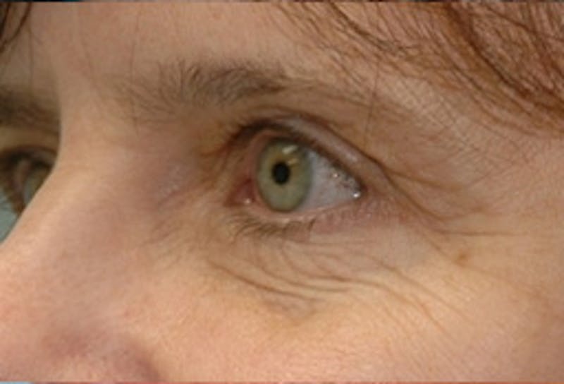Blepharoplasty Before & After Gallery - Patient 379930 - Image 1