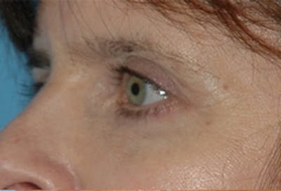 Blepharoplasty Before & After Gallery - Patient 379930 - Image 2