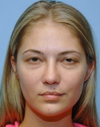 Blepharoplasty Before & After Gallery - Patient 393258 - Image 1