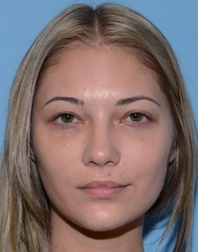 Blepharoplasty Before & After Gallery - Patient 393258 - Image 2