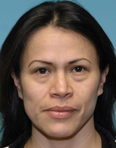 Blepharoplasty Before & After Gallery - Patient 226314 - Image 1