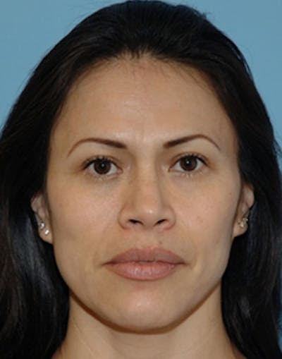 Blepharoplasty Before & After Gallery - Patient 226314 - Image 2