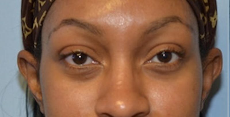 Blepharoplasty Before & After Gallery - Patient 231573 - Image 1
