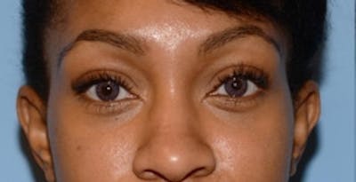 Blepharoplasty Before & After Gallery - Patient 231573 - Image 2