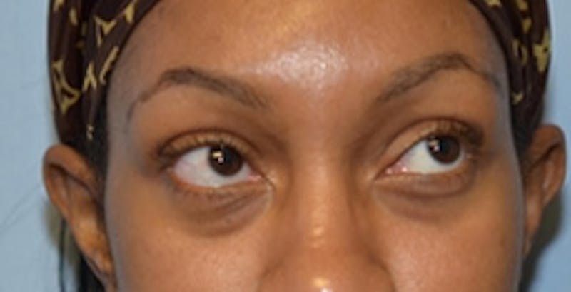 Blepharoplasty Before & After Gallery - Patient 231573 - Image 3