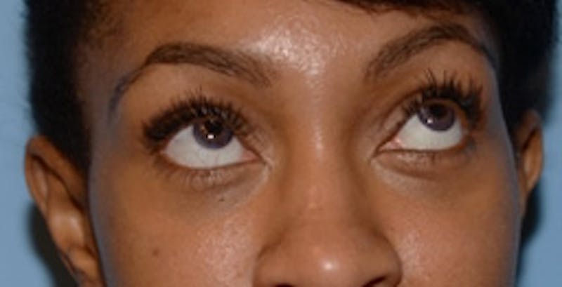 Blepharoplasty Before & After Gallery - Patient 231573 - Image 4