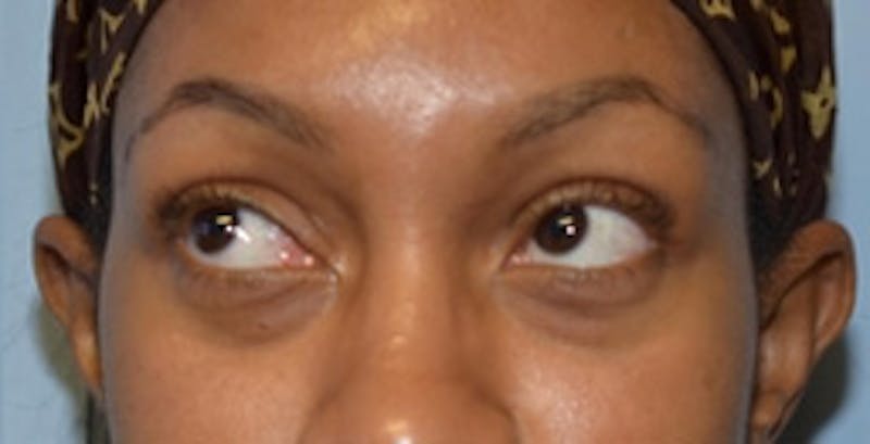 Blepharoplasty Before & After Gallery - Patient 231573 - Image 5