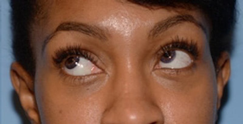 Blepharoplasty Before & After Gallery - Patient 231573 - Image 6