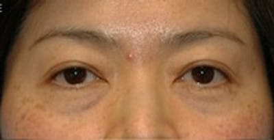 Blepharoplasty Before & After Gallery - Patient 353221 - Image 1