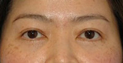 Blepharoplasty Before & After Gallery - Patient 353221 - Image 2