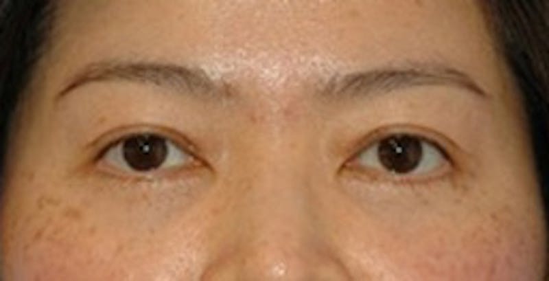 Blepharoplasty Before & After Gallery - Patient 353221 - Image 2