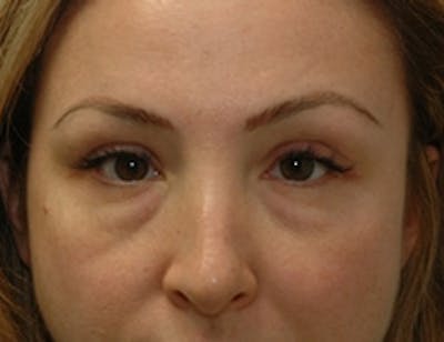 Blepharoplasty Before & After Gallery - Patient 348300 - Image 1