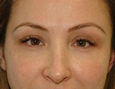 Blepharoplasty Before & After Gallery - Patient 348300 - Image 2