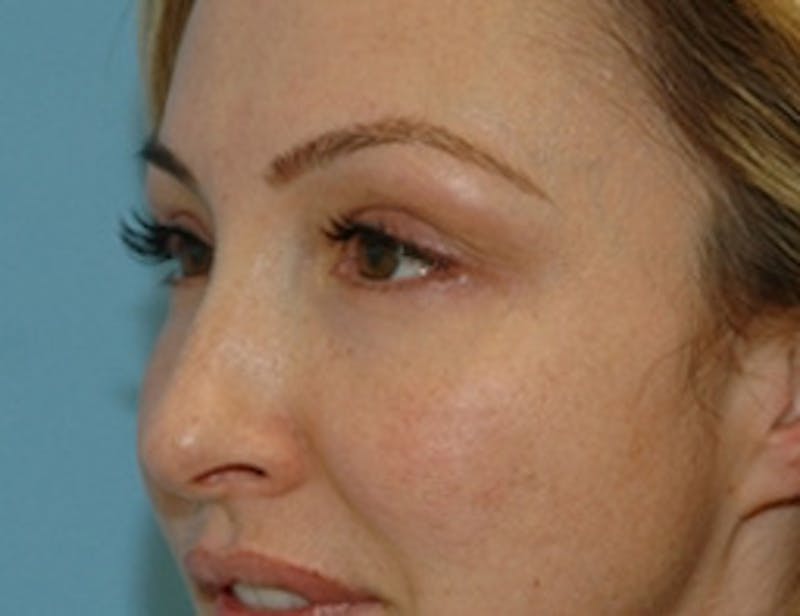 Blepharoplasty Before & After Gallery - Patient 348300 - Image 4