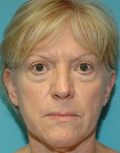 Blepharoplasty Before & After Gallery - Patient 163006 - Image 1