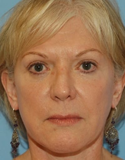 Blepharoplasty Before & After Gallery - Patient 163006 - Image 2