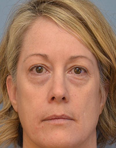 Blepharoplasty Before & After Gallery - Patient 150587 - Image 1