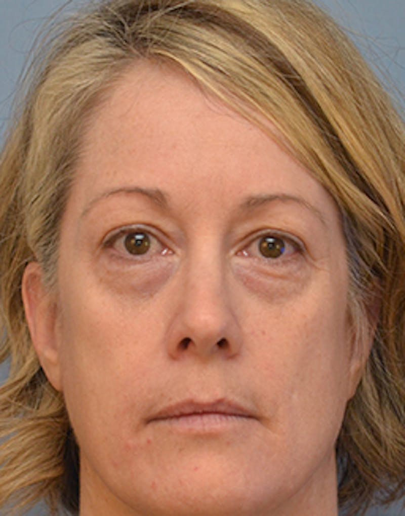 Blepharoplasty Before & After Gallery - Patient 150587 - Image 1