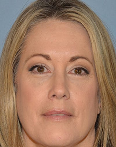 Blepharoplasty Before & After Gallery - Patient 150587 - Image 2