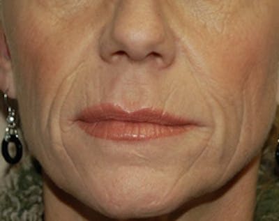 Fat Transfer Before & After Gallery - Patient 637625 - Image 1