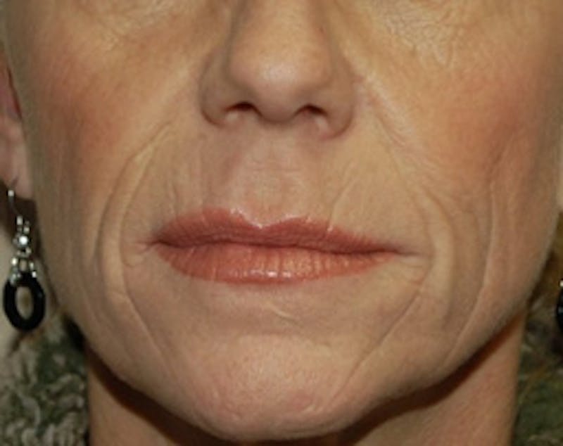 Fat Transfer Before & After Gallery - Patient 637625 - Image 1