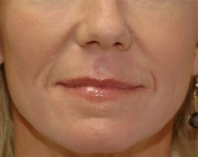 Fat Transfer Before & After Gallery - Patient 637625 - Image 2