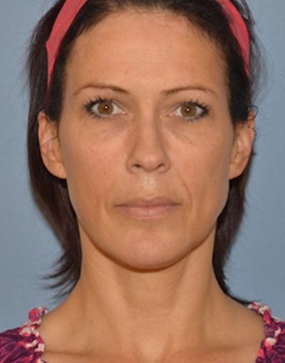 Fat Transfer Before & After Gallery - Patient 426901 - Image 2