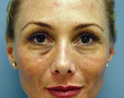 Fat Transfer Before & After Gallery - Patient 355137 - Image 1