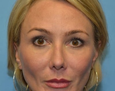 Fat Transfer Before & After Gallery - Patient 355137 - Image 2