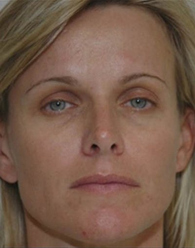 Fat Transfer Before & After Gallery - Patient 224039 - Image 1