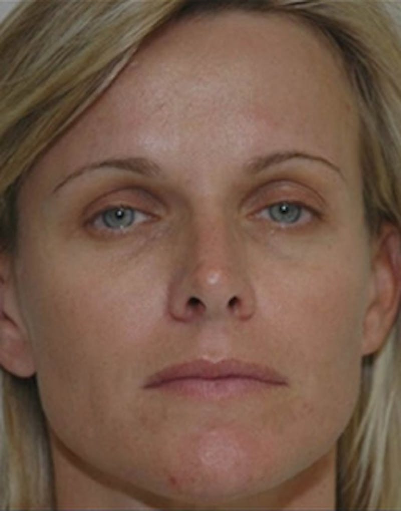 Fat Transfer Before & After Gallery - Patient 224039 - Image 1