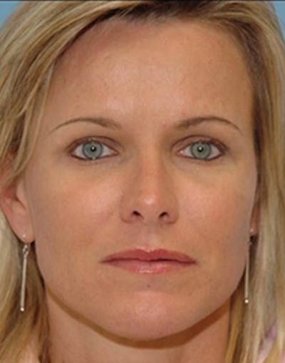 Fat Transfer Before & After Gallery - Patient 224039 - Image 2
