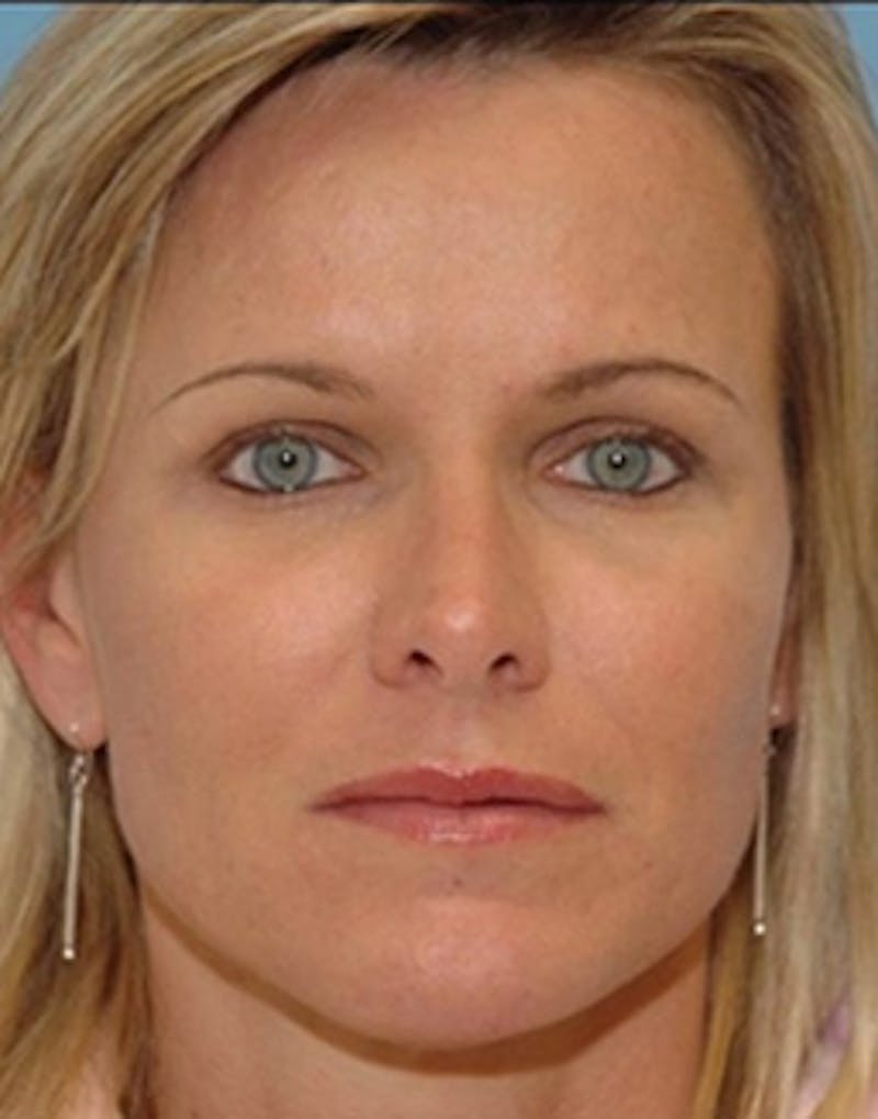 Fat Transfer Before & After Gallery - Patient 224039 - Image 2