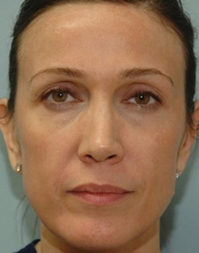 Fat Transfer Before & After Gallery - Patient 208170 - Image 1
