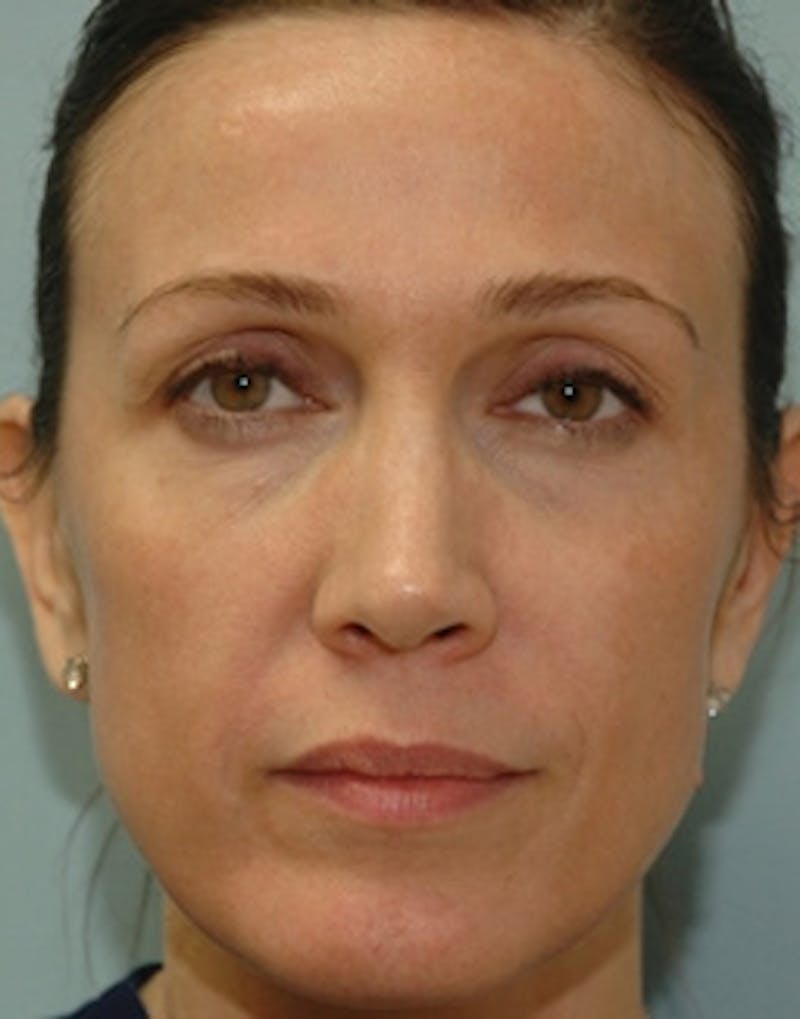 Fat Transfer Before & After Gallery - Patient 208170 - Image 1