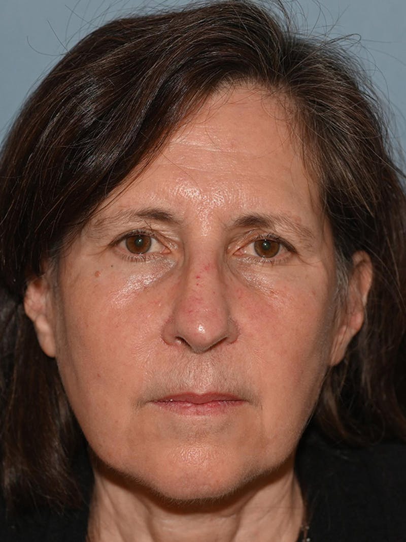 Brow Lift Before & After Gallery - Patient 104022 - Image 1