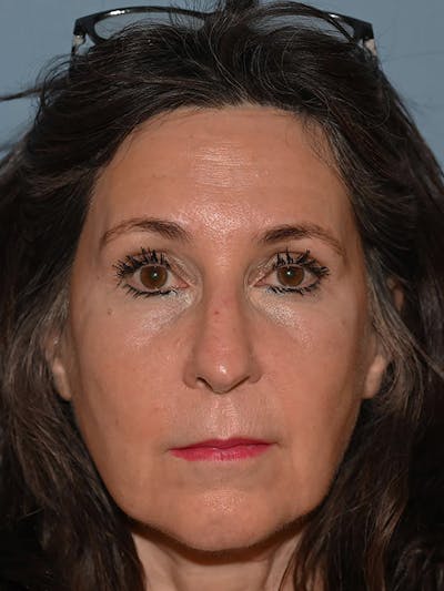 Brow Lift Before & After Gallery - Patient 104022 - Image 2