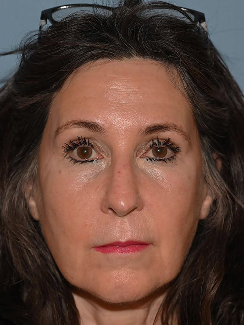 Brow Lift Before & After Gallery - Patient 104022 - Image 2