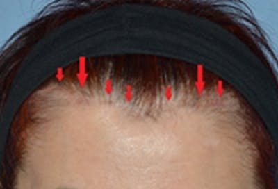 Brow Lift Before & After Gallery - Patient 282695 - Image 1