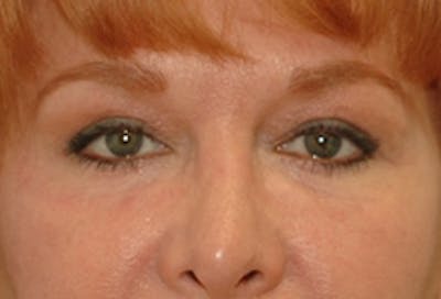 Brow Lift Before & After Gallery - Patient 362472 - Image 2