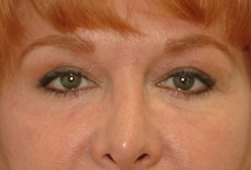 Brow Lift Before & After Gallery - Patient 362472 - Image 2