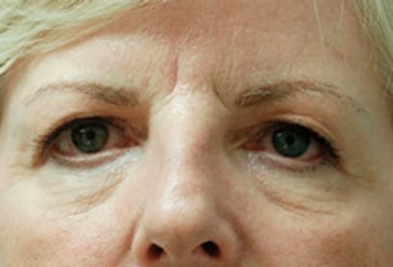 Brow Lift Before & After Gallery - Patient 169544 - Image 1